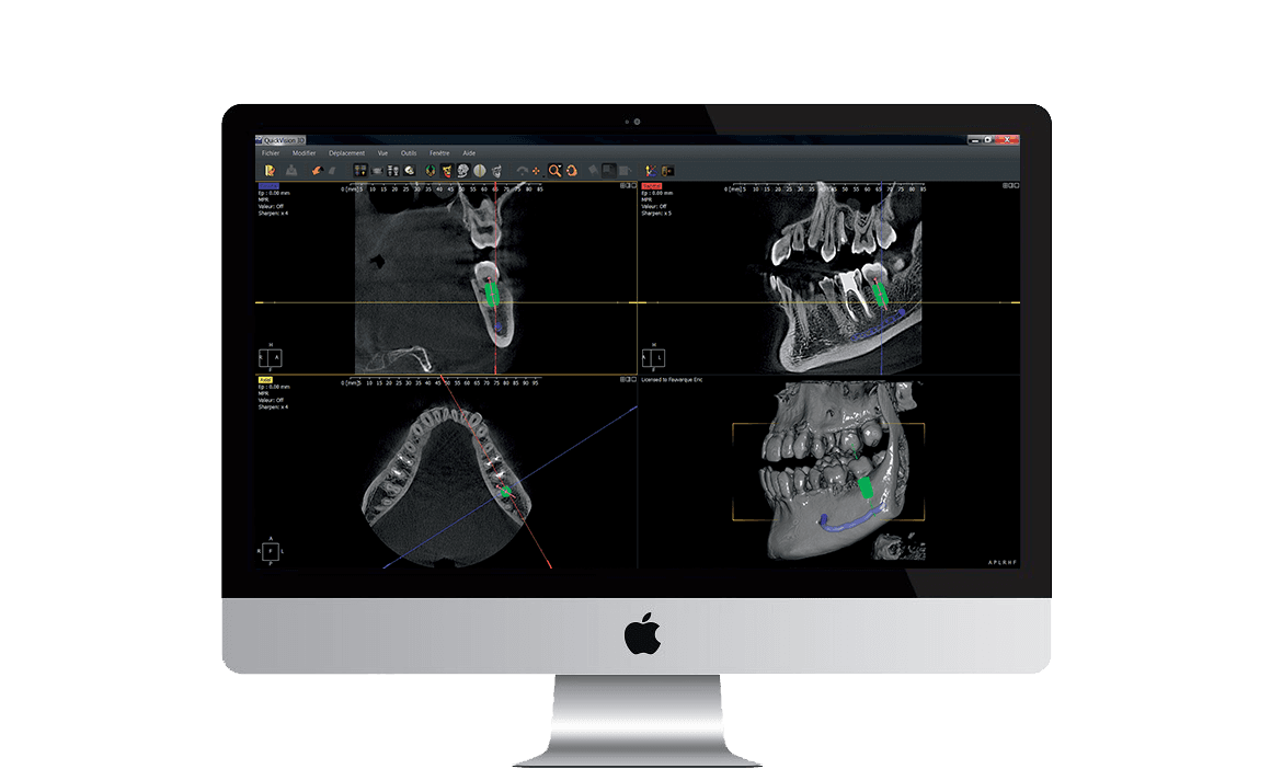 QuickVision 3D Software de planificación de implantes