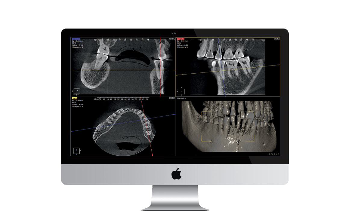 QuickVision 3D Software de planificación de implantes