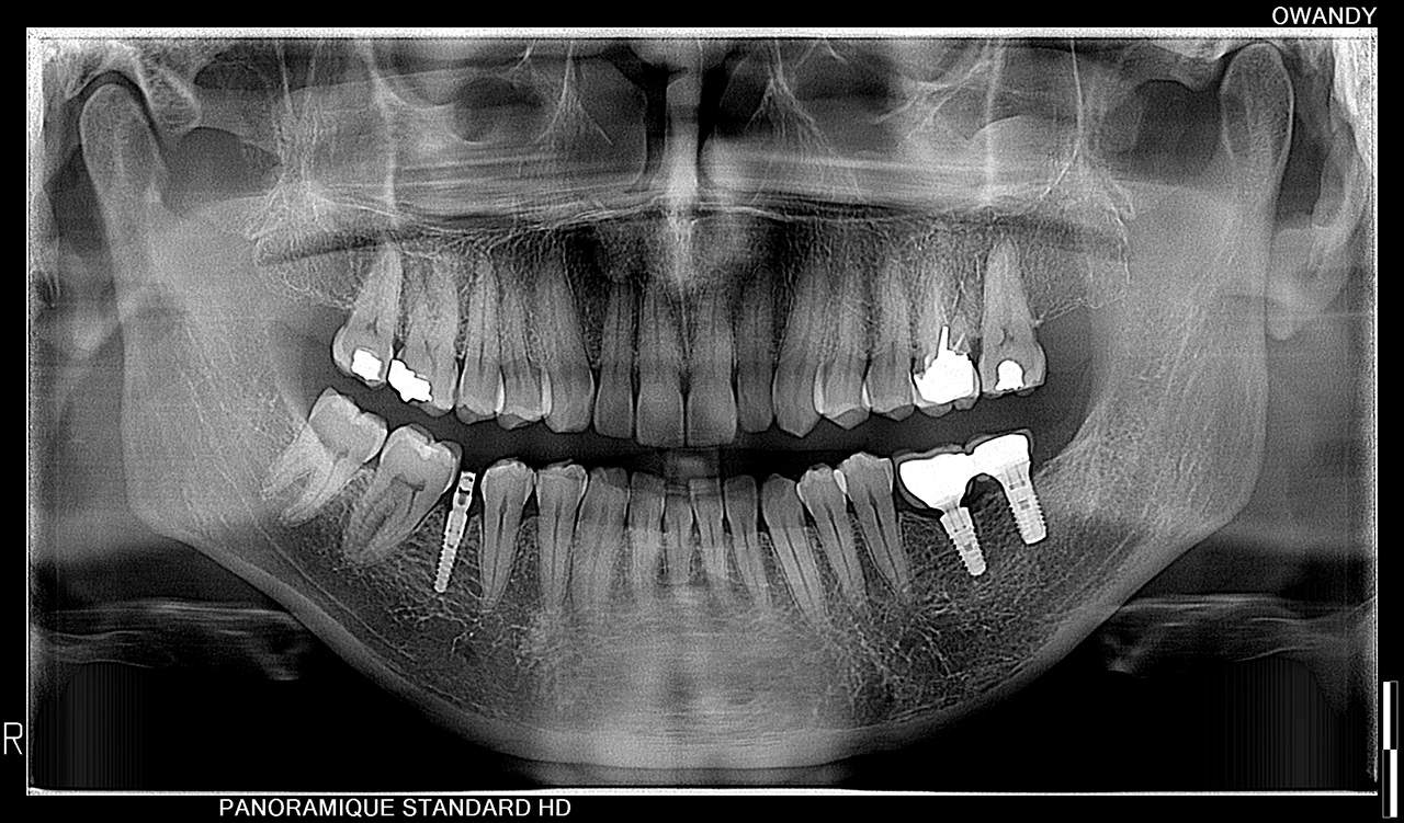 Panorámica dental