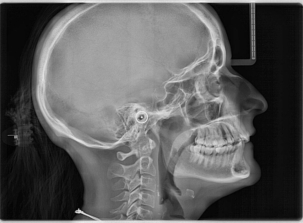 TAC Dental I-Max 3D Ceph Pro - Radiografía cefalométrica