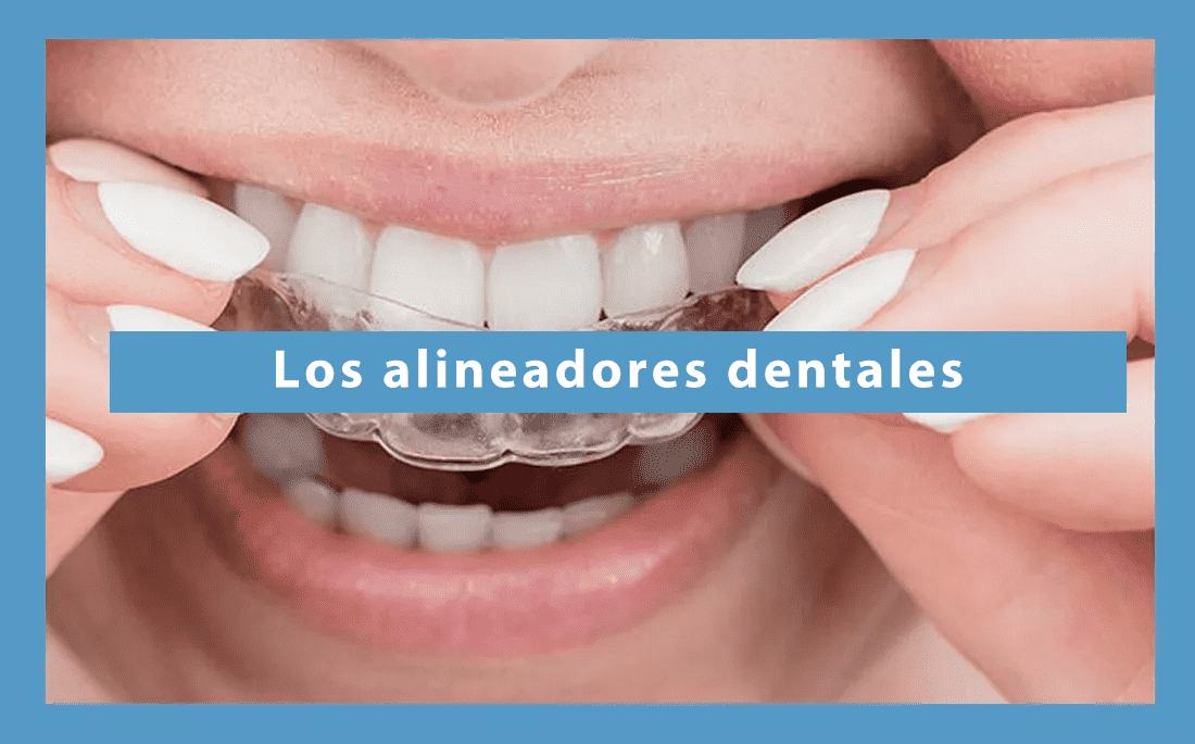 Los alineadores dentales: una alternativa pertinente a los sistemas ortodónticos convencionales