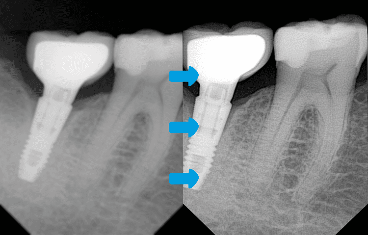 ONE Sensor X-Ray hd-quality